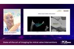State-of-the-art imaging for mitral valve interventions - PCR Valves e-Course 2020 - Video