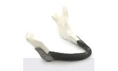 3D Medical - Mandible Implant