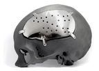 Kune - Model PEEK - Custom Implant for Neurosurgery