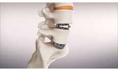 The SPIRA Open Matrix ALIF - Video