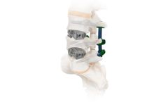 Spira - Model OLIF - Open Matrix Implant