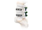 Spira - Model LLIF - Titanium Open Architecture Implant