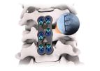 GRUVE - Anterior Cervical Plate System
