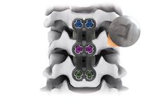 IRIS - Anterior Cervical Plate System