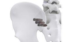 Life Spine - Model SImpact - Sacroiliac Joint Fixation Screw System