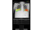 Lunit - Version INSIGHT CXR - AI Solution for Chest X-ray