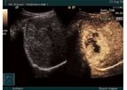 Ultrasound