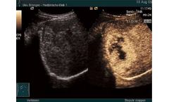 Ultrasound