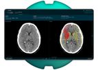 Brainomix - Version e-ASPECTS - Transforming Stroke Care Through Simple Imaging