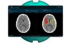 Brainomix - Version e-ASPECTS - Transforming Stroke Care Through Simple Imaging