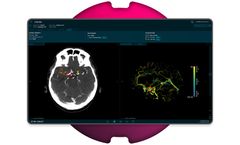 Brainomix - Version e-CTA - Advanced Solutions to Support Stroke Treatment Decisions