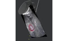 Aim - 3D Needle Navigation Software for Simpler, Safer and More-Effective Procedures
