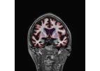 NeuroQuant - Version Dementia - Age Related Atrophy Report Software
