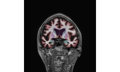 NeuroQuant - Version Dementia - Age Related Atrophy Report Software