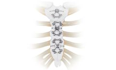 SternaLock - Model XP - Rigid Fixation System