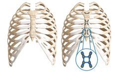 SternaLock Blu - Versus Wires