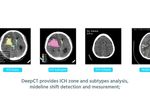 DeepCT - AI identification of ICH and other critical findings - Video