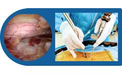 dualPortal - Novel Two-Portal Endoscopic Approach