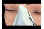 Septo-Rhinoplasty 3D Protocol - Piezotome M+ - Video