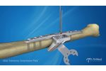 TriMed Ulnar Osteotomy Compression Plate: The market leaders - Video