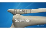 TriMed`s Sidewinder is used to treat Weber B, short oblique fibula fractures without lag screws! - Video