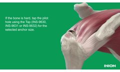 Inion FixOn Biocomposite Suture Anchor - Rotator Cuff Repair - Video