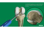 Inion ACL Reconstruction - Video