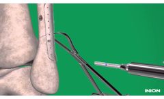 Inion Freedom System - Ankle Fracture Repair - Video