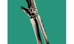 Inion FreedomPlate - Fracture Fixation System