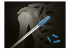 Inion FixOn - Biocomposite Suture Anchor