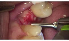 Socket Diamond Debridement - Video