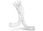 Artivion - Model E-tegra - Stent Graft System