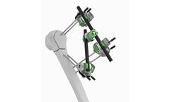 Orthofix - Model 1E.1 - Proximal Humeral Fracture