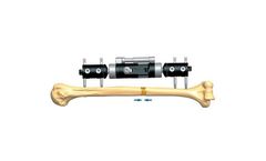 Orthofix - Model 1E.26 - Non Union of Humeral Shaft Treated