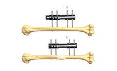 Orthofix - Model 1E.29 - Lengthening