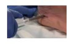 COREX - Calcaneus - Video