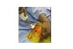 COREX Proximal Tibial Bone Graft - Video