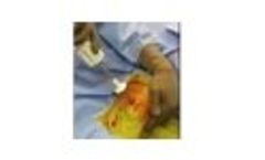 COREX Proximal Tibial Bone Graft - Video