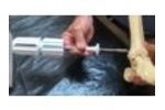 COREX - Distal Tibia - Video
