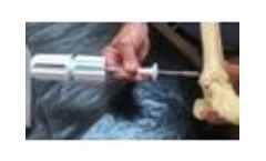 COREX - Distal Tibia - Video