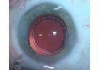 CAPSULASER - Selective Laser Capsulotomy System