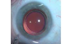 CAPSULASER - Selective Laser Capsulotomy System