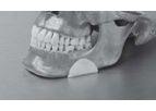 Matrix - Osteotomy Gap Implant