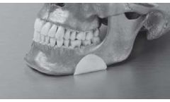 Matrix - Osteotomy Gap Implant