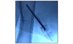 Marxman - Deflective Bone Marrow Aspiration System
