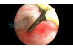 ESC Medicams Full HD 1080p Endoscopy Camera for Urology - Video