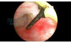 ESC Medicams Full HD 1080p Endoscopy Camera for Urology - Video