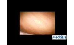 ScoutCam 1.2 CMOS camera - knee exploration - Video