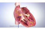 SinusFlex??? decapolar mapping catheter - Redefining CS placement - Video