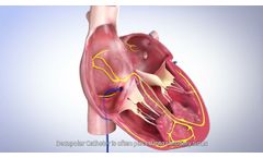 SinusFlex??? decapolar mapping catheter - Redefining CS placement - Video